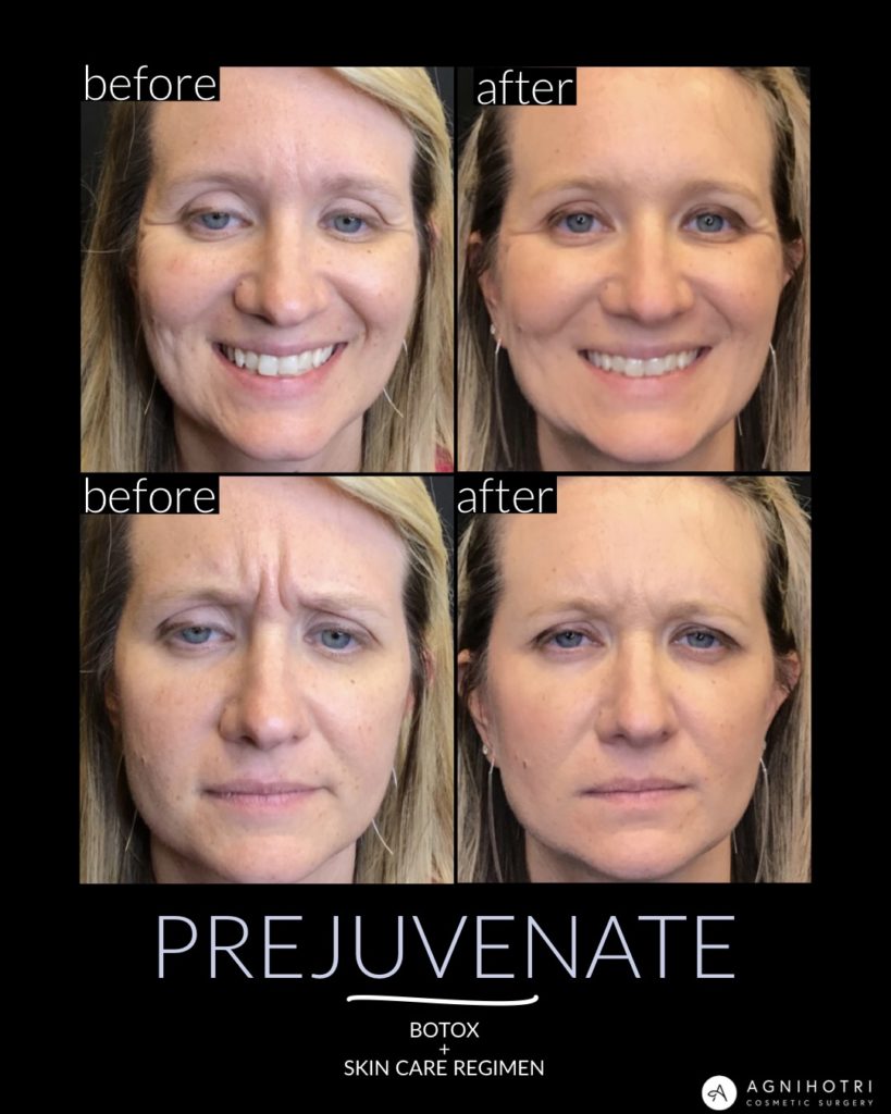 four photos of before and after Prejuvenate botox and skin care regimen