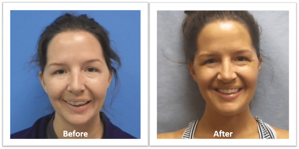 before and afters of woman with jaw surgery