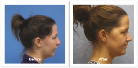 side view before and after photos of woman with jaw surgery