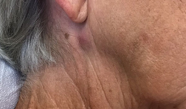 woman's neck before cyst removal