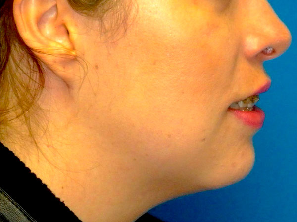 side of woman's face after face lift