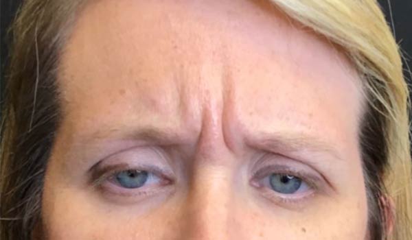 closeup photo of wrinkles in between woman's eyes