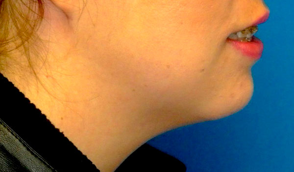 side view of woman's mouth and chin after mandibular implants