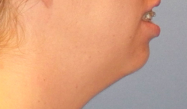 side view of boy's chin before mandibular implants