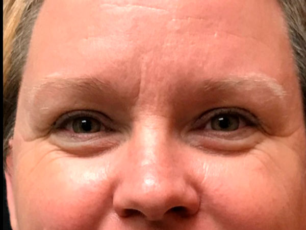 close up of woman's face before microneedling treatment