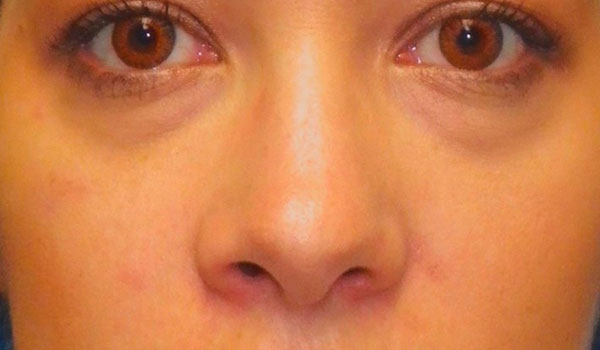 closeup of woman's face after mole removal
