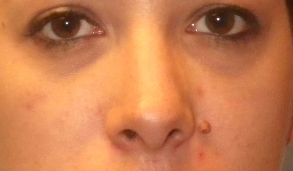 close up of woman's face with a mole