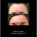 before and after photos of woman's forehead with dysport neuromodulator