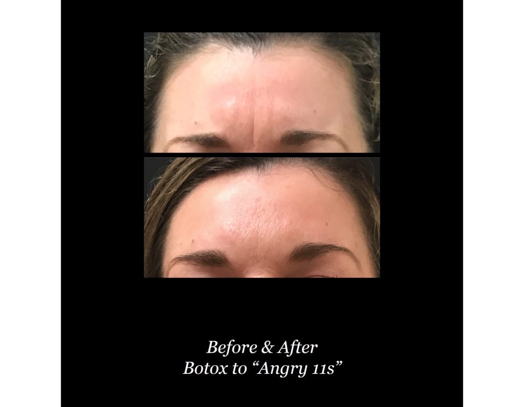 before and after photos of woman's forehead with dysport neuromodulator