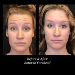 before and after photos of woman with forehead botox