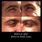before and after photos of botox on man's smile lines