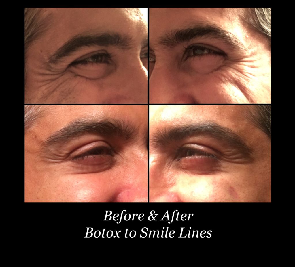 before and after photos of botox on man's smile lines