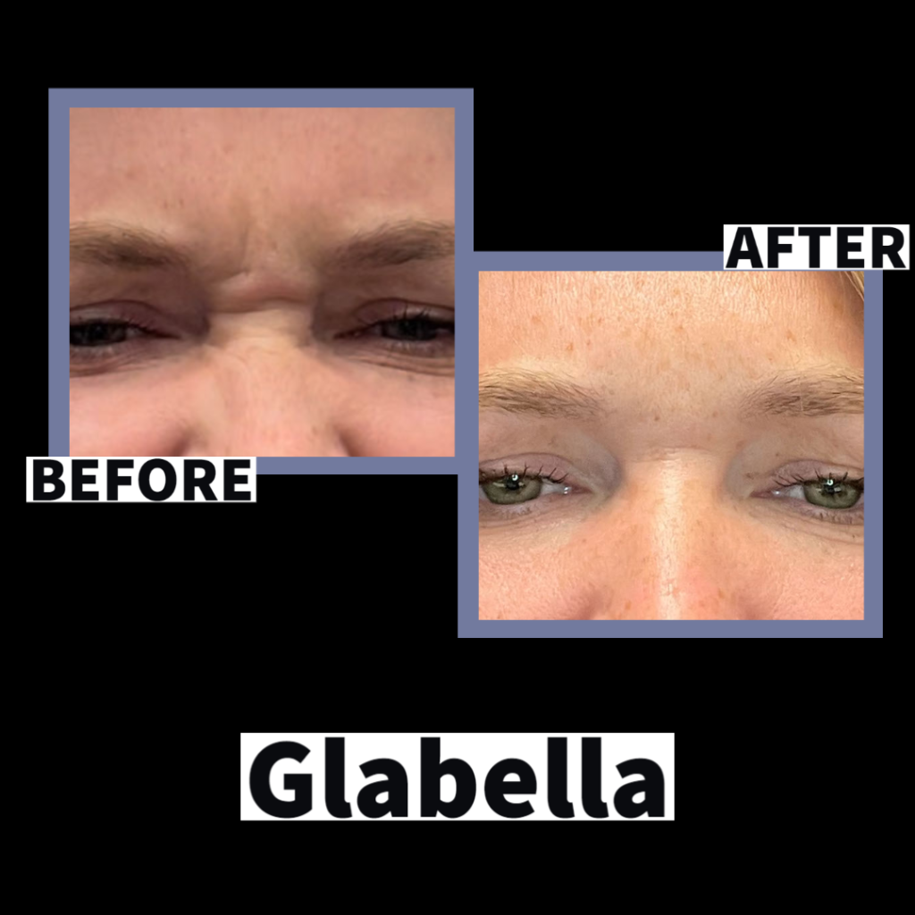 Botox Results