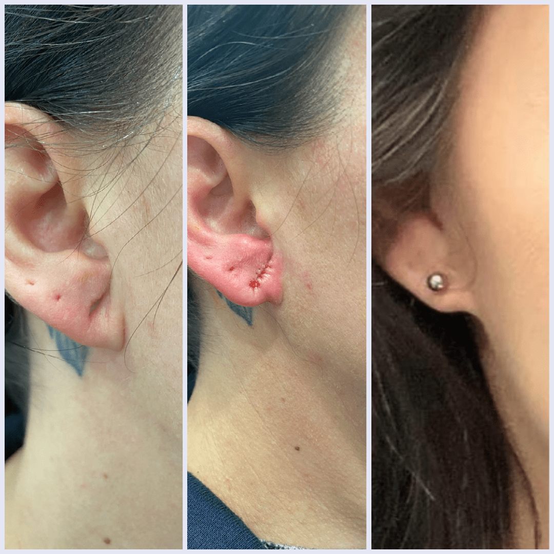 Ear Lobe Gauge Repair