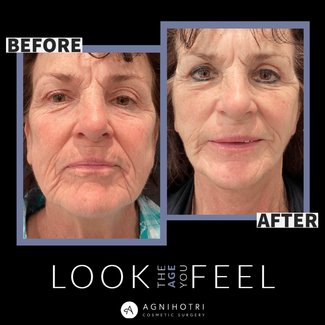 Facelift Results