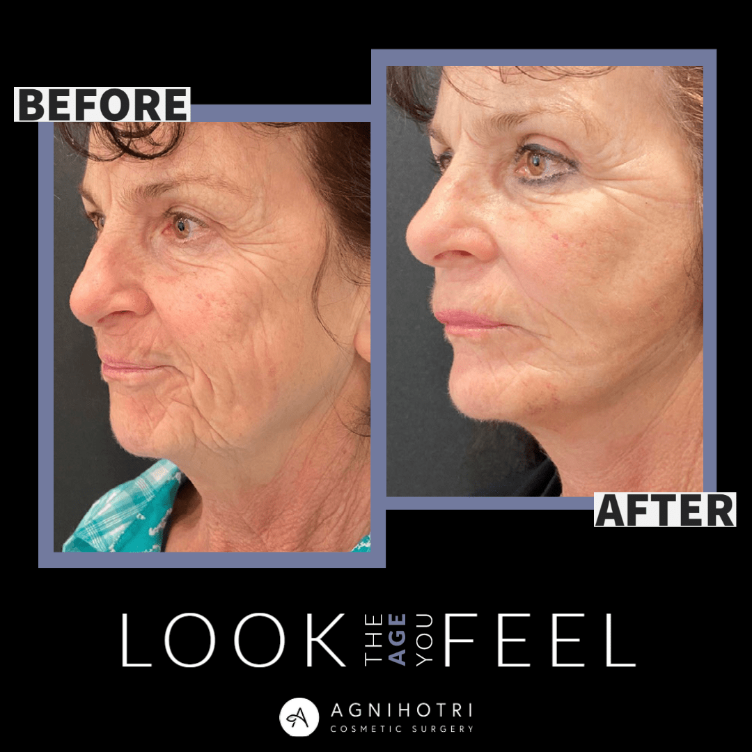 facelift Results