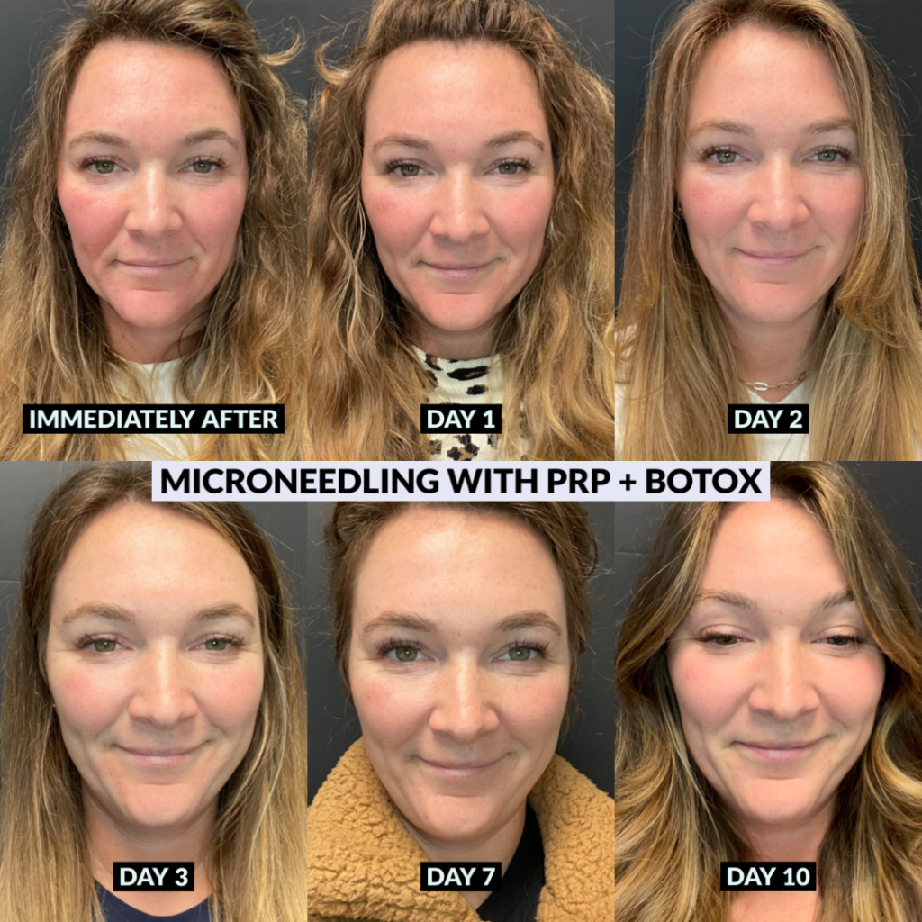 microneedling results