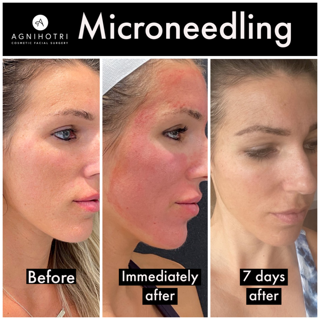 microneedling results